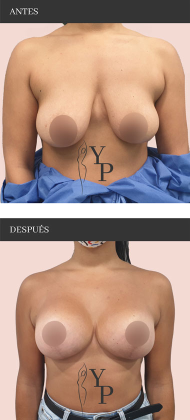 Elevacion-Mama-Tuberosa