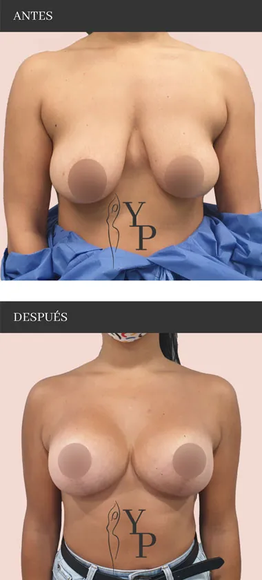 Elevacion-Mama-Tuberosa