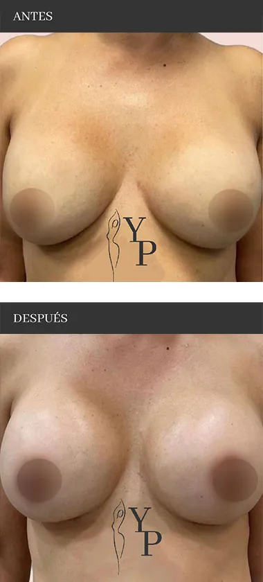 Antes y después operación recambio de protesis