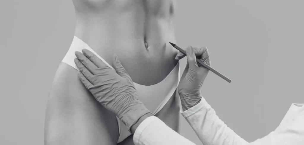 Liposucción abdominal- qué es y su técnica