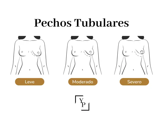 grados de pecho tubular infografía