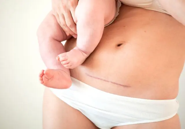 Abdominoplastia para quitar cicatriz de cesárea