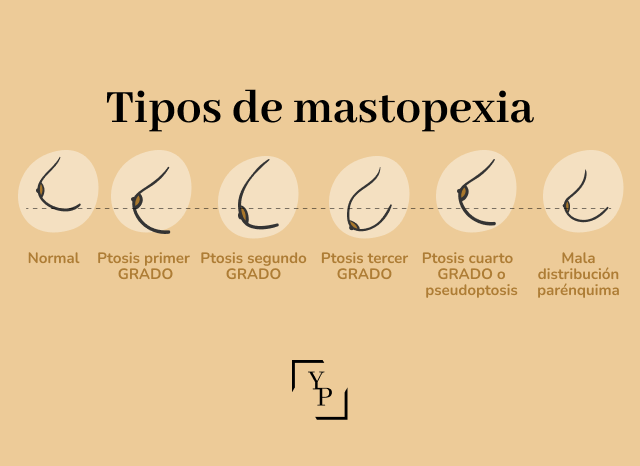 tipos de senos caídos