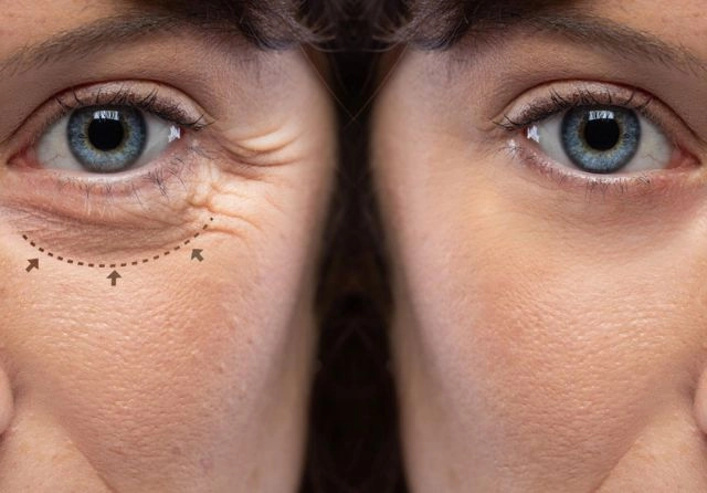 blefaroplastia después de un mes