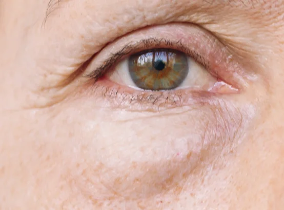 blefaroplastia Tenerife