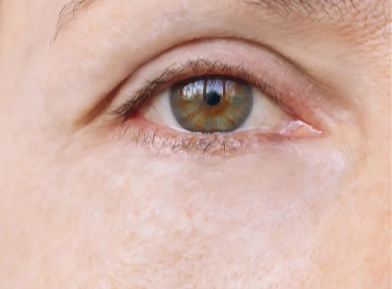 operacion de parpados caidos Tenerife