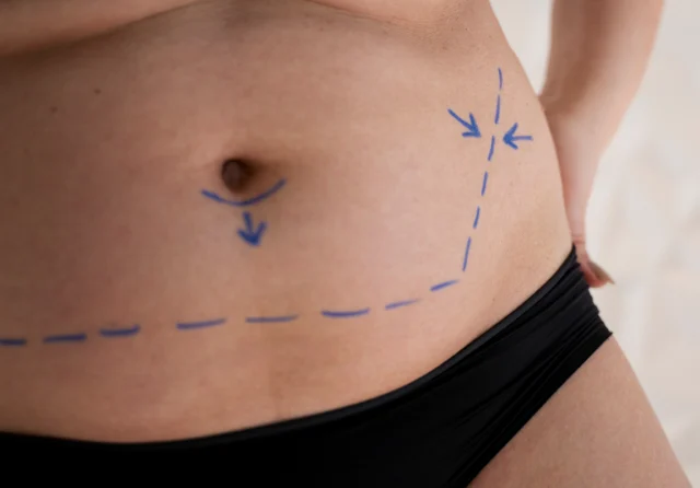 Miniabdominoplastia con desinserción umbilical