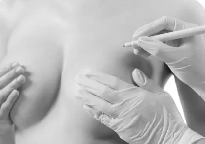 Mamoplastia tecnica submuscular Dual Plane Tenerife