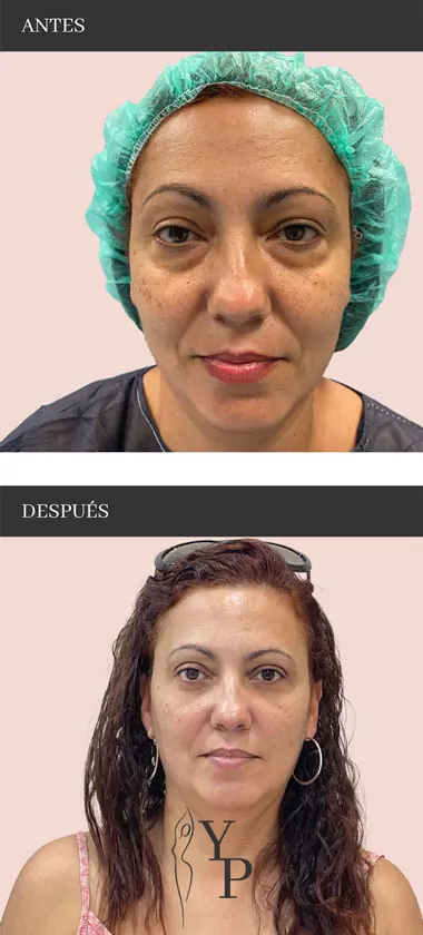 Blefaroplastia