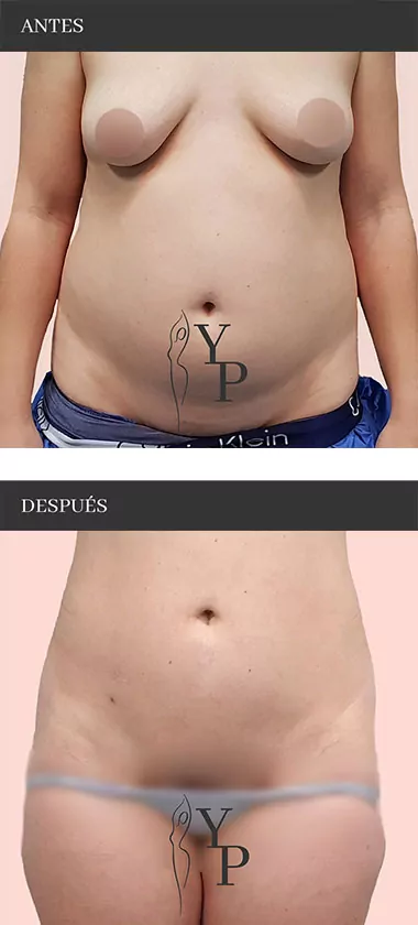 Antes y después de operación liposucción