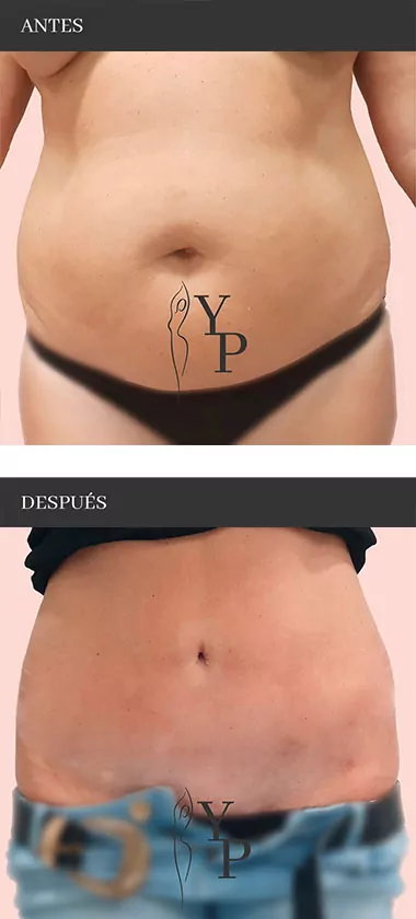 Antes y después de operación de abdominoplastia